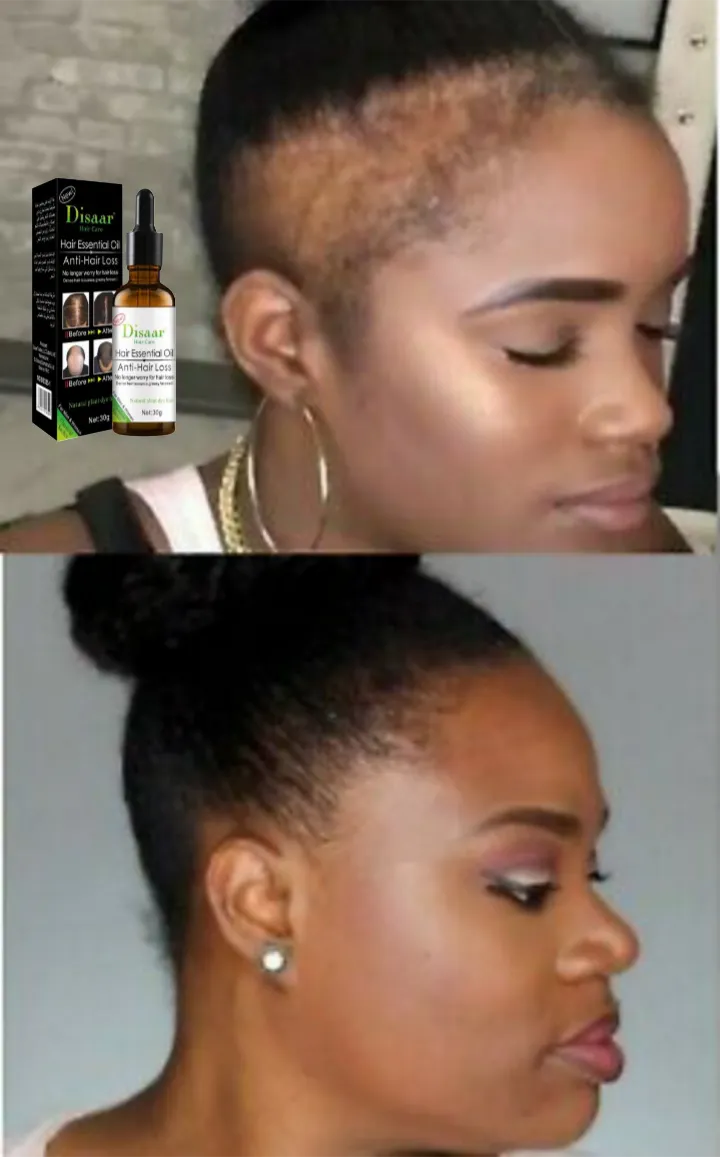 l'Huile Essentielle Anti-Chute et Croissance  des Cheveux
