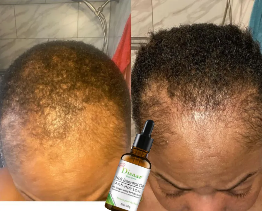 l'Huile Essentielle Anti-Chute et Croissance  des Cheveux