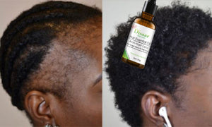 l'Huile Essentielle Anti-Chute et Croissance  des Cheveux