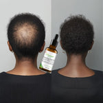 l'Huile Essentielle Anti-Chute et Croissance  des Cheveux