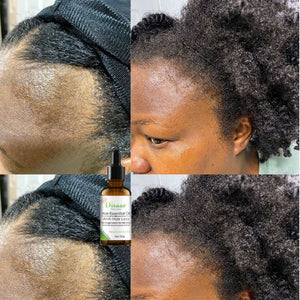 l'Huile Essentielle Anti-Chute et Croissance  des Cheveux
